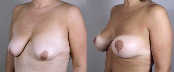 Mommy Makeover Patient 14