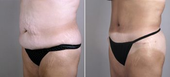 Mommy Makeover Patient 14