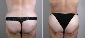 Mommy Makeover Patient 14