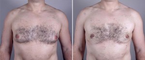 Male Breast Reduction New Jersey Image