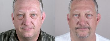 Male Eyelid Lift Patient 7