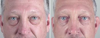 Male Eyelid Lift Patient 7
