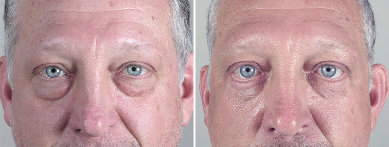 Male Eyelid Lift Patient 7