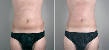 Male Abdominoplasty Patient 5