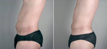 Male Abdominoplasty Patient 5