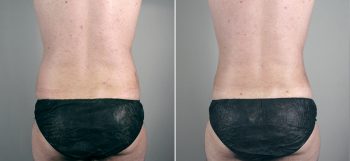 Male Abdominoplasty Patient 5