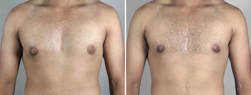 Gynecomastia Reduction Patient 13