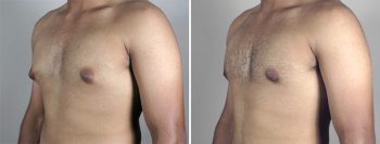 Gynecomastia Reduction Patient 13