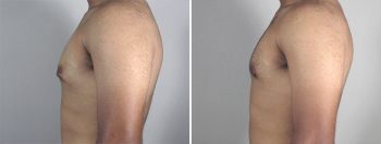Gynecomastia Reduction Patient 13