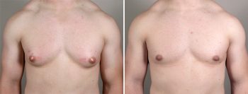 Gynecomastia Reduction Patient 14