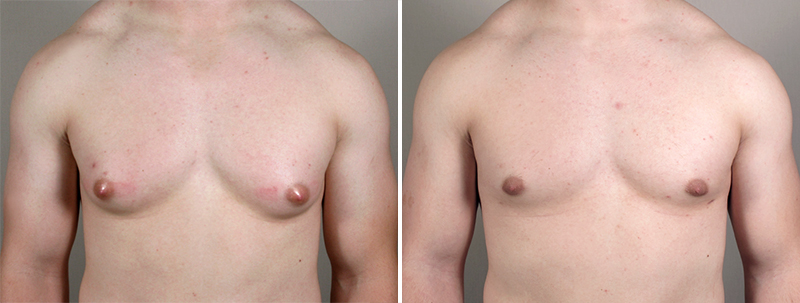 Gynecomastia Reduction Patient 14