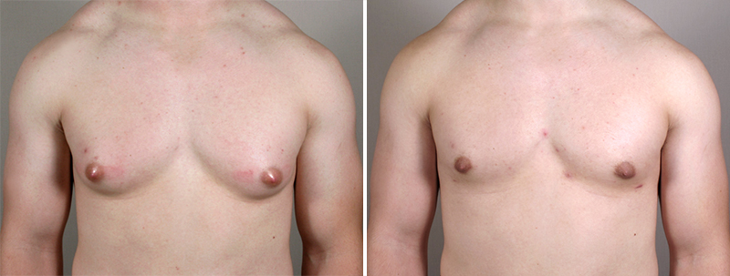 Male Breast Reduction New Jersey Image