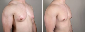 Gynecomastia Reduction Patient 14