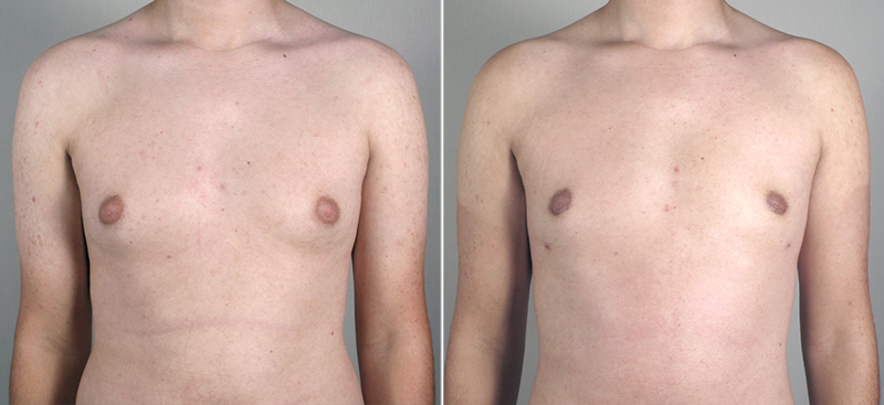 Male Abdominoplasty Patient 5