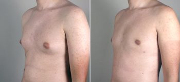 Male Abdominoplasty Patient 5