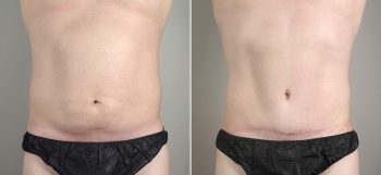 Male Abdominoplasty Patient 4