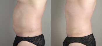 Male Abdominoplasty Patient 4
