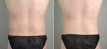 Male Abdominoplasty Patient 4