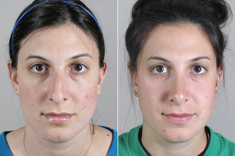 Rhinoplasty Patient 21