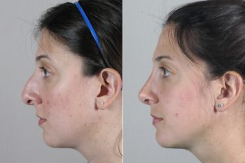 Rhinoplasty Patient 21