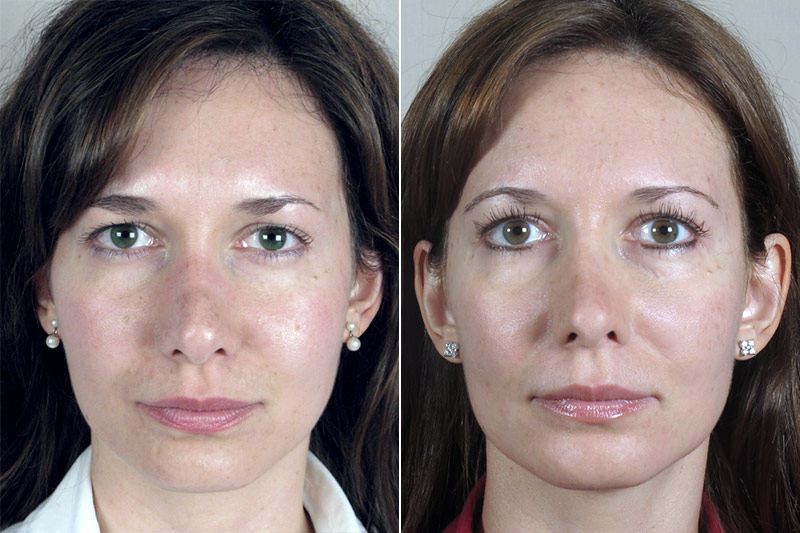 Rhinoplasty Patient 23