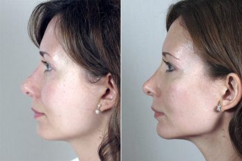 Rhinoplasty Patient 23