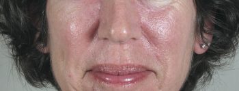 Skin Cancer Treatment Patient 15