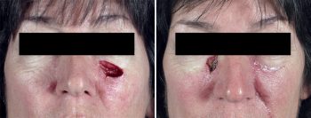 Skin Cancer Treatment Patient 15
