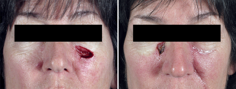 Skin Cancer Treatment Patient 15