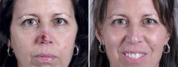 Skin Cancer Treatment Patient 16