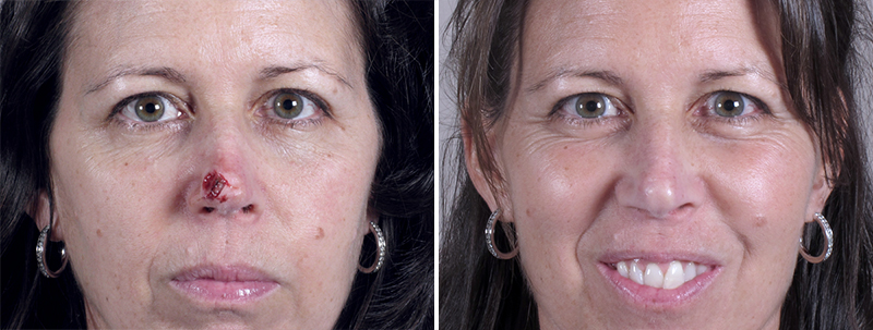 Skin Cancer Treatment Patient 16