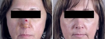 Skin Cancer Treatment Patient 17