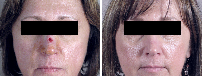 Skin Cancer Treatment Patient 17