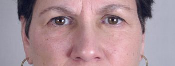 Skin Cancer Treatment Patient 18