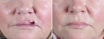 Skin Cancer Treatment Patient 19