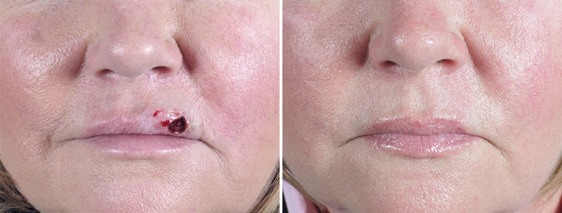 Skin Cancer Treatment Patient 19