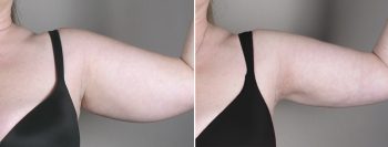 Upper Arm Rejuvenation Patient 6 – Liposuction