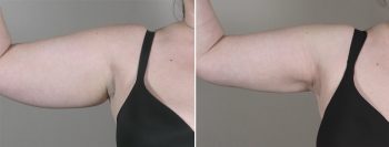 Upper Arm Rejuvenation Patient 6 – Liposuction