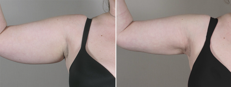 Upper Arm Rejuvenation Patient 6 – Liposuction