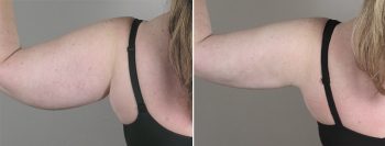 Upper Arm Rejuvenation Patient 6 – Liposuction