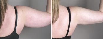 Upper Arm Rejuvenation Patient 6 – Liposuction