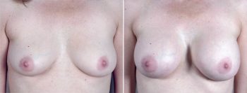 Mommy Makeover Patient 22