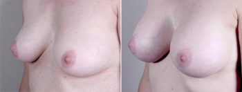 Mommy Makeover Patient 22