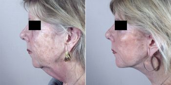 Facelift Patient 14