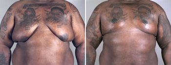 Gynecomastia Reduction Patient 17