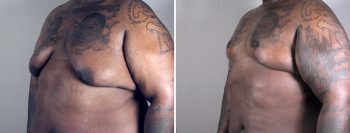 Gynecomastia Reduction Patient 17