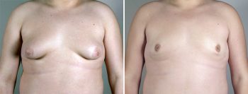 Gynecomastia Reduction Patient 16