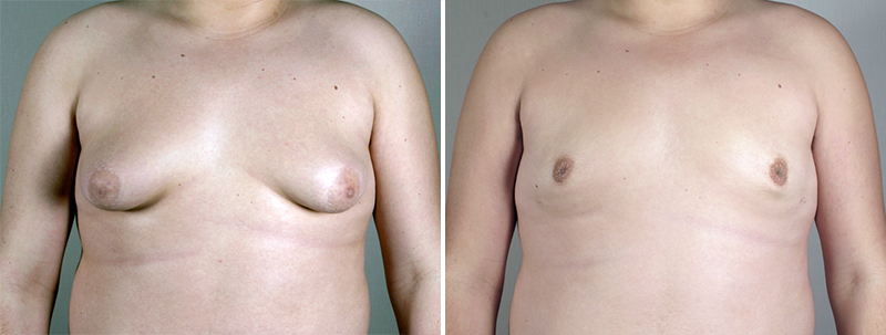 Gynecomastia Reduction Patient 16