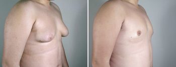 Gynecomastia Reduction Patient 16