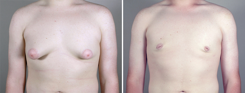 Gynecomastia Reduction Patient 18